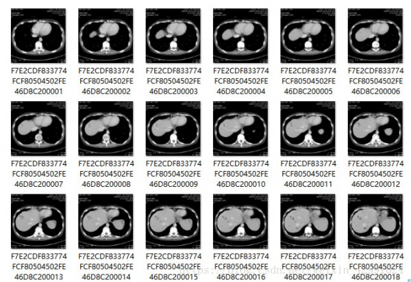 MicroDicom viewer